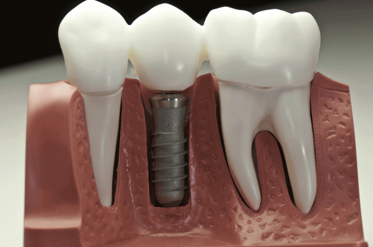 What To Think About While Thinking About Dental Implants