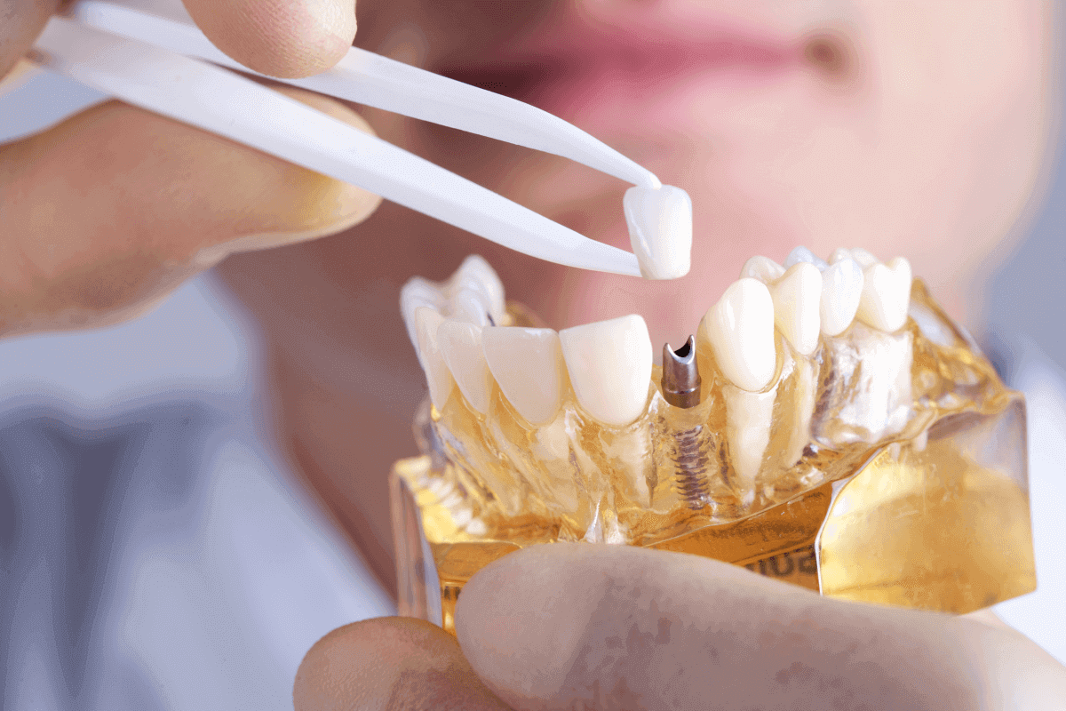 What are the Benefits of Having Dental Implants?