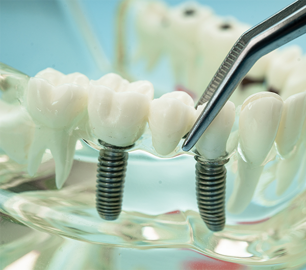 Dental Implants in Vancouver