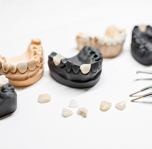 Dental Crowns in Vancouver