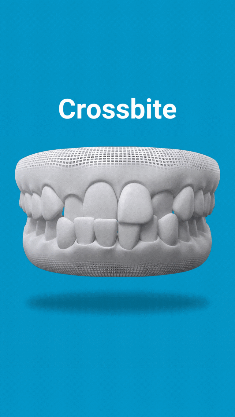 Crossbite-768x1365 Invisalign Fixes Crossbite