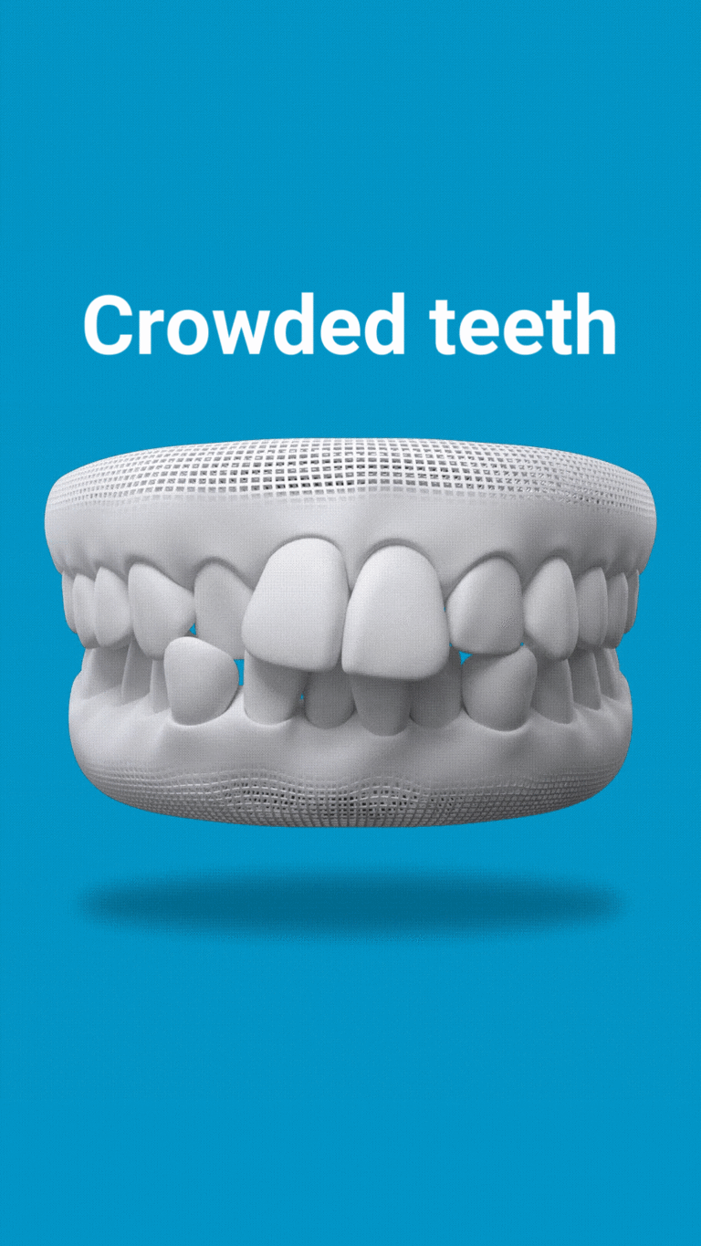 Crowded-teeth-768x1365 Invisalign Fixes Crowded Teeth