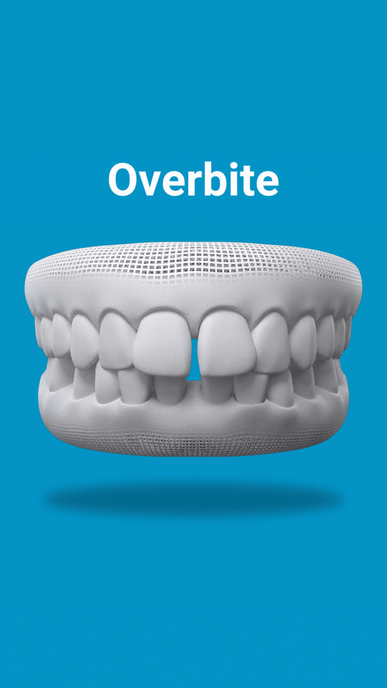 Overbite-768x1365 Invisalign Fixes Overbite
