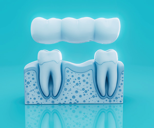 Dental Bridges in Vancouver | Tooth Bridge Yaletown ✅