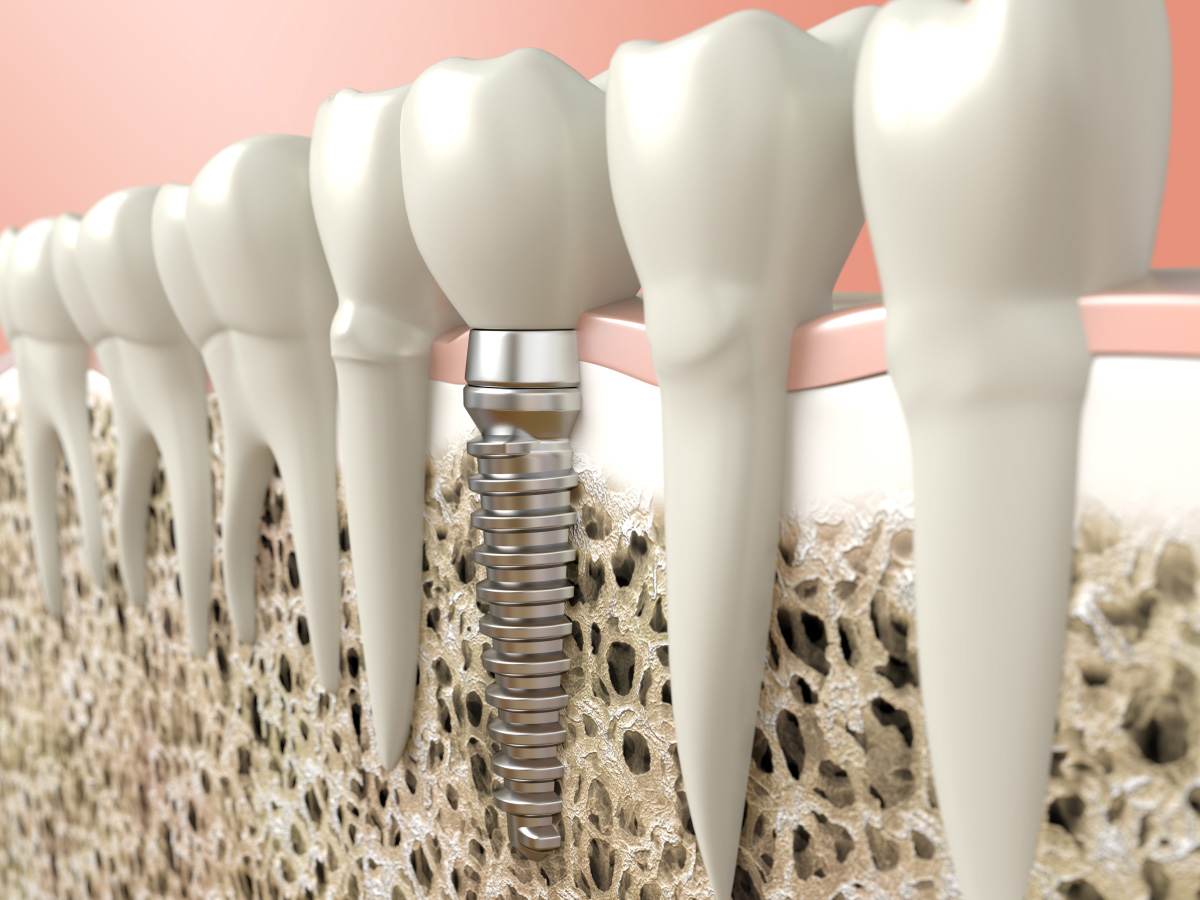 Considering Dental Implants? What You Need To Know