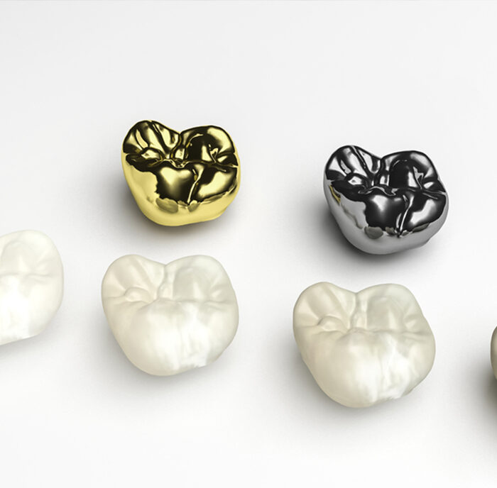 Dental crowns Yaletown Vancouver Dental crowns Yaletown Vancouver