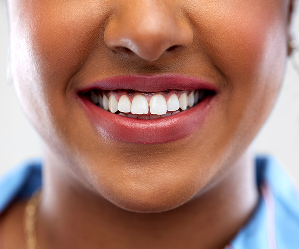 teeth bonding yaletown vancouver