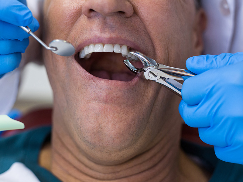 Tooth Extraction in Vancouver | Greenwoods Dental Yaletown ✅