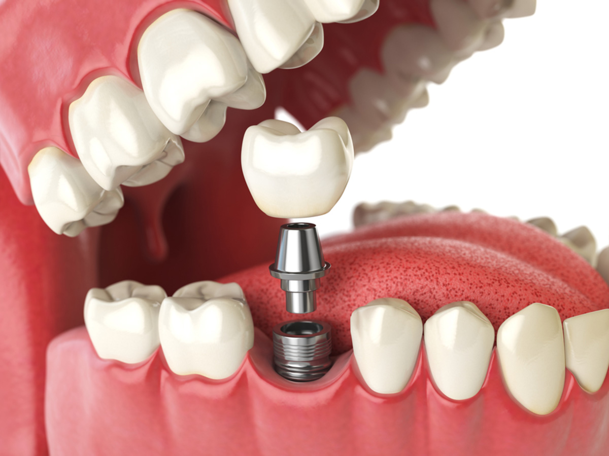 Why Consider Dental Implants