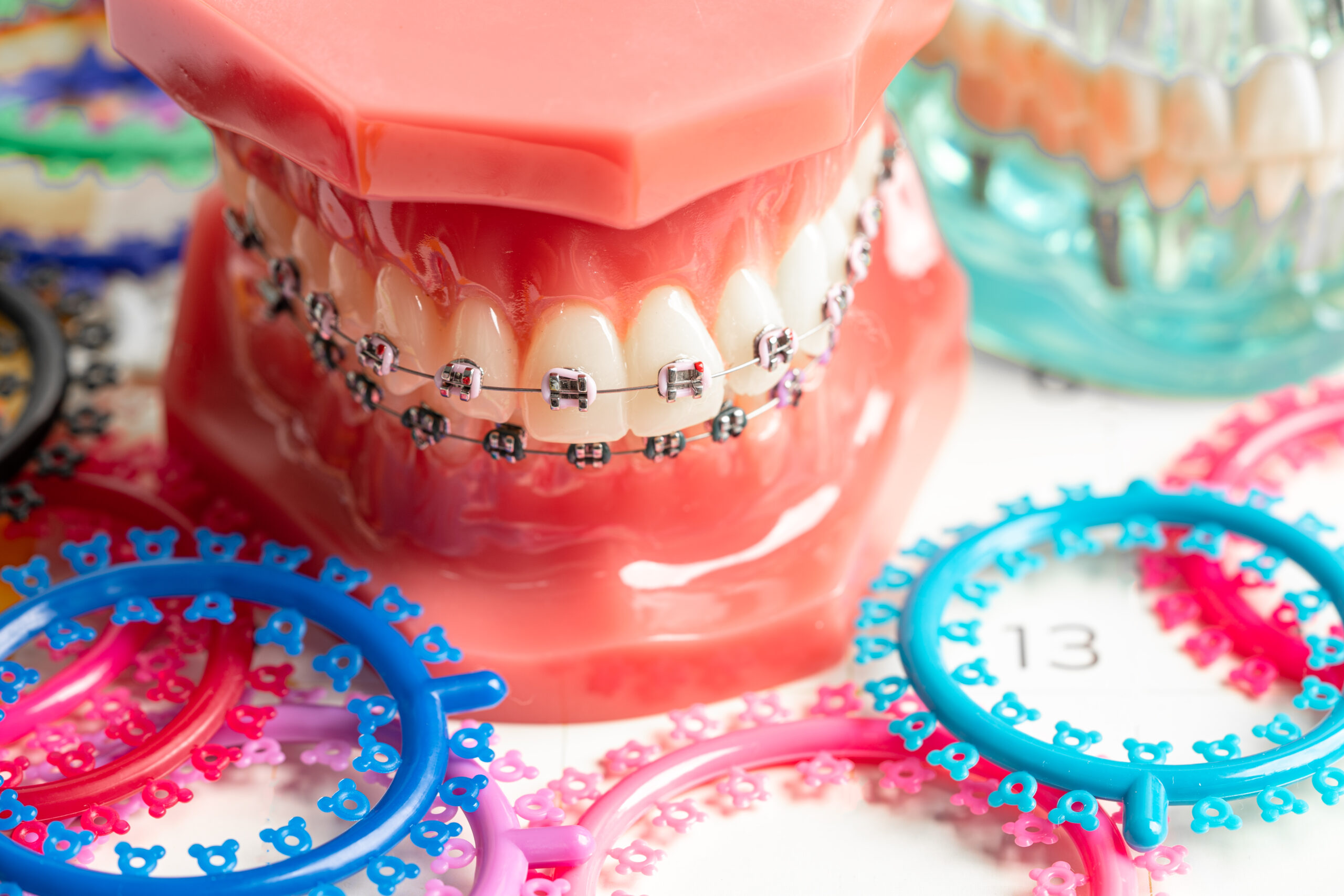 Unlocking Your Perfect Smile: Exploring the Benefits of Braces