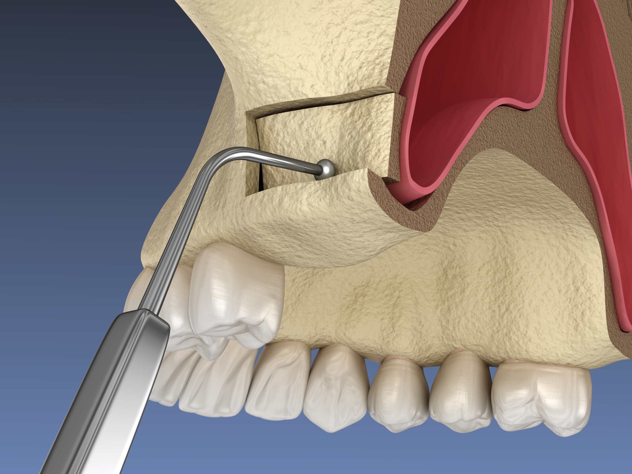 Rejuvenate Your Oral Wellness with Sinus Lift Surgery